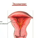 Эндометрит - показание к назначению Клавама