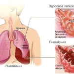 Клавам эффективен при лечении пневмонии