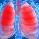 Если вовремя не начато лечение возможно развитие эмфиземы легких