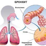 Пастилки и сироп назначают при остром и хроническом бронхите