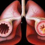 Если имеются гнойные процессы в бронхах или повышение температуры тела выше +37°С, ингаляции запрещены