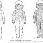 Осложнением кори может стать трахеидный бронхит