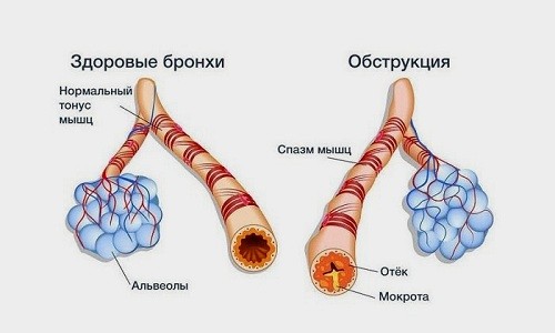 Обструктивный бронхит у грудничка без температуры - воспалительный процесс, сопровождающийся закупоркой просвета бронхов