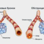 Обструктивный бронхит инфекционной и аллергической природы может спровоцировать развитие патологии