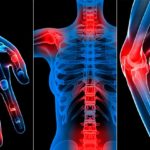 Ацетилсалициловая кислота принимается при ревматизме