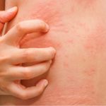 При использовании свечей иногда развивается аллергия (высыпания, кожный зуд)