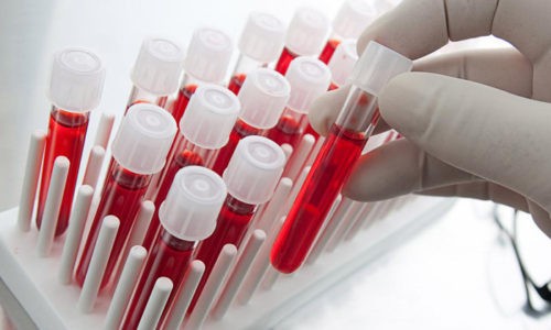 Общий анализ крови при бронхите считают одним из способов диагностики, который позволяет найти изменения характеристик биологической жидкости при развитии болезни