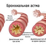 Со временем патология прогрессирует, появляется вероятность развития бронхиальной астмы или хронической обструктивной болезни легких (ХОБЛ)