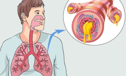 Бронхит без кашля - это патология, при которой воспаляется слизистая бронхов, но отсутствует основной симптом болезни - кашель