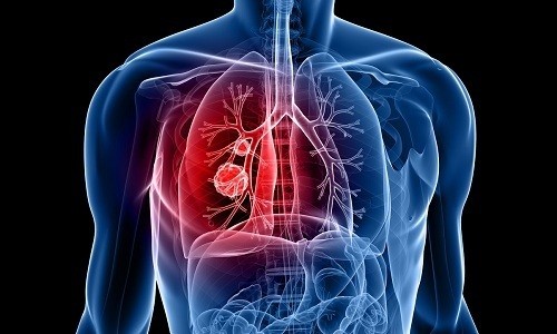Деформирующий бронхит - это патологическое состояние, развивающееся на фоне частых острых воспалительных процессов, протекающих в органах дыхания