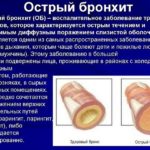 Острый бронхит у ребенка часто возникает как осложнение на фоне сезонных ОРВИ