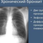 Хронический бронхит развивается в форме осложнения на этапе острой стадии заболевания