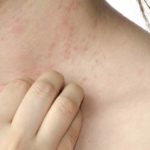 После приема Ципролета могут возникнуть кожные аллергические проявления