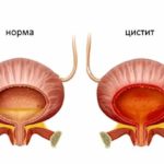 Клавам показан при лечении цистита