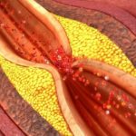 Препарат используется для профилактики тромбообразования