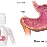 Противопоказания Нимесулида является язва желудка