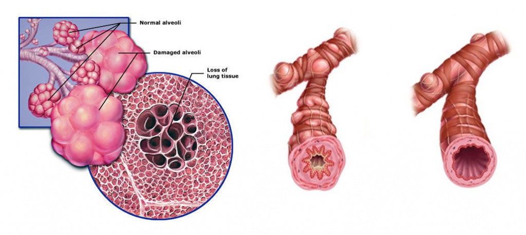 Эмфизема хронического бронхита. Обструктивная болезнь лёгких (ХОБЛ). Хроническая обструктивная болезнь легких.