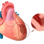 Источником кровотечения является инфаркт легкого