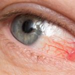 Препарат помогает в лечении аллергического конъюнктивита