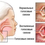 Пастилки и сироп назначают при ларингите
