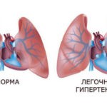 Осложнением бронхита может стать легочная гипертензия. Чаще всего она развивается из-за того, что лечение было проведено не в полном объеме