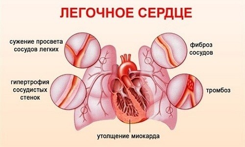 При прогрессировании бронхита возможно формирование легочного сердца