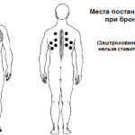 Места постановки банок при бронхите
