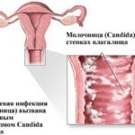 Также Юнидокс Cолютаб назначают при молочнице