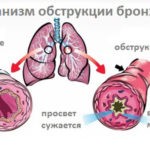 Обструктивный бронхит характеризуется тем, что слизистая оболочка легких не просто воспаляется, а еще и повреждается