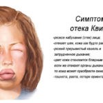 При приеме таблеток и введении раствора возможен отек Квинке