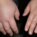 Признаком бронхоэктазы является утолщение фаланг пальцев и ногтевых пластин
