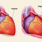 Антибиотик предназначен для лечения перикардита