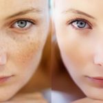 При помощи солодки можно вывести пигментные пятна