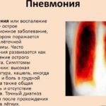 Наличие влажных хрипов может указывать на развитие пневмонии