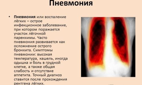 Нередко на фоне бронхита возникает пневмония — воспаление легких