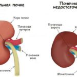 Почечная недостаточность замедляет вывод препарата из организма