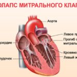 Пролапс митрального клапана