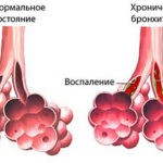 Основное проявление хронического бронхита - сильный кашель в течение трехмесячного периода более двух лет подряд