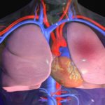 Отек легких появляется также при передозировке Ацетилсалициловой кислотой