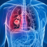 При раке лёгких могут назначить анализ крови