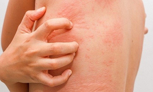 При появлении признаков аллергии курс лечения Полиоксидонием прекращают