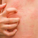 Гнойничковая или аллергическая сыпь являются противопоказаниями к проведению массажа