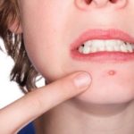 Доктор Мом противопоказан при повреждениях кожи