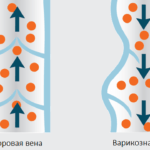 Варикозное расширение вен появляется из-за непроходимости сосудов, которое возникло в результате образования тромба (сгустка крови). Ацетилсалициловая кислота обладает свойством разжижения крови, что необходимо для улучшения кровообращения