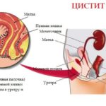 Препарат назначается при хроническом цистите