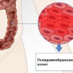 После приема лекарства у некоторых пациентов развивается псевдомембранозный колит