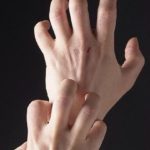 При высокой чувствительности к компонентам препарата прекратить прием